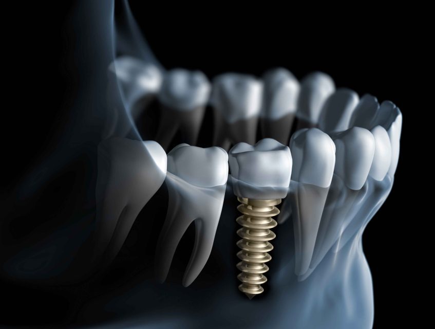 diş implant