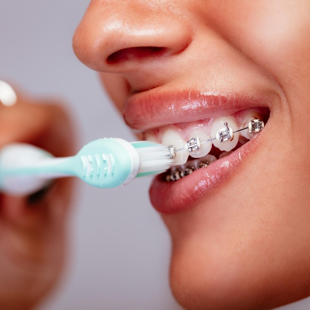 Diş Teli ile Ortodontik Tedavide İdeal Ağız Hijyeni Nasıl Sağlanır ?