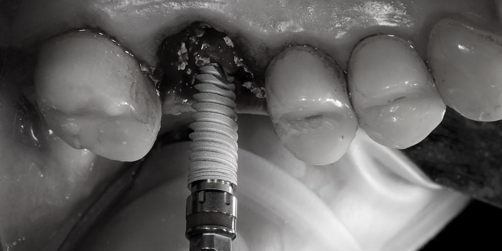 hemen implant diş