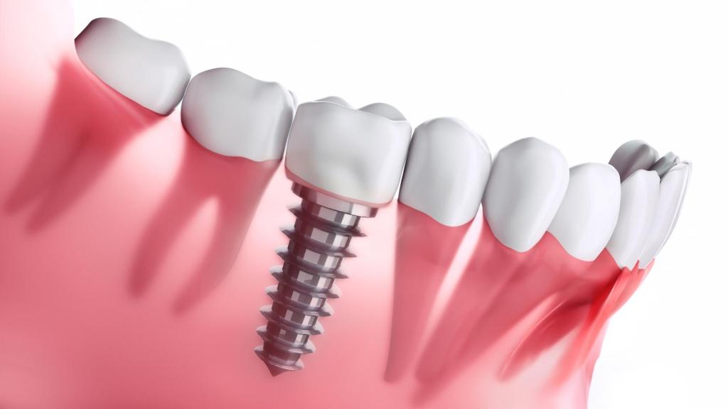 implant diş taktıranlar