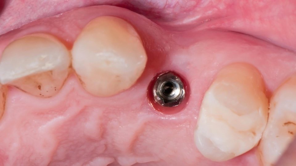 diş çekimi ve implant diş