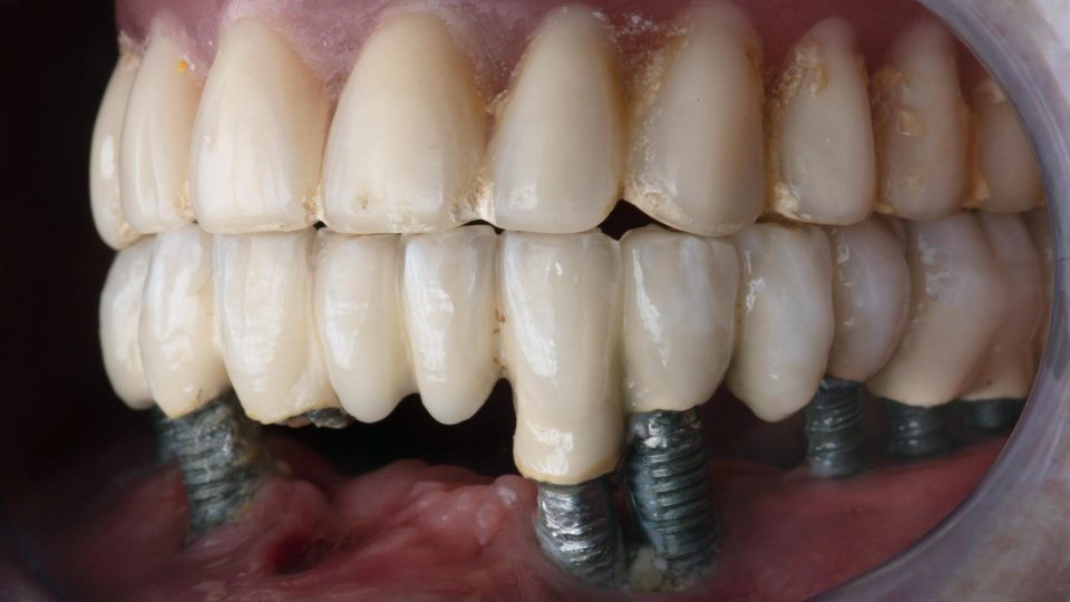 implant diş eti çekilmesi