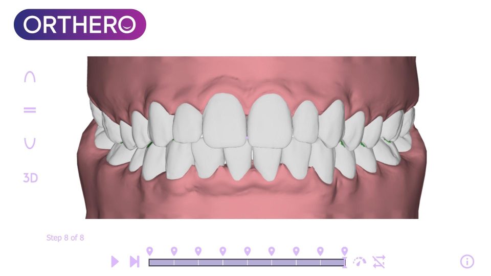 orthero nevşehir görünmez ortodonti