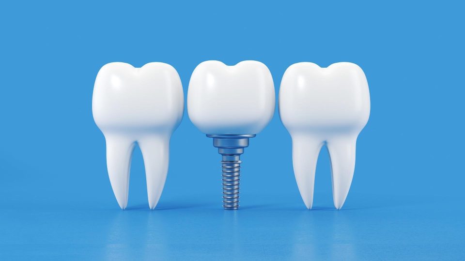 dental implant nedir