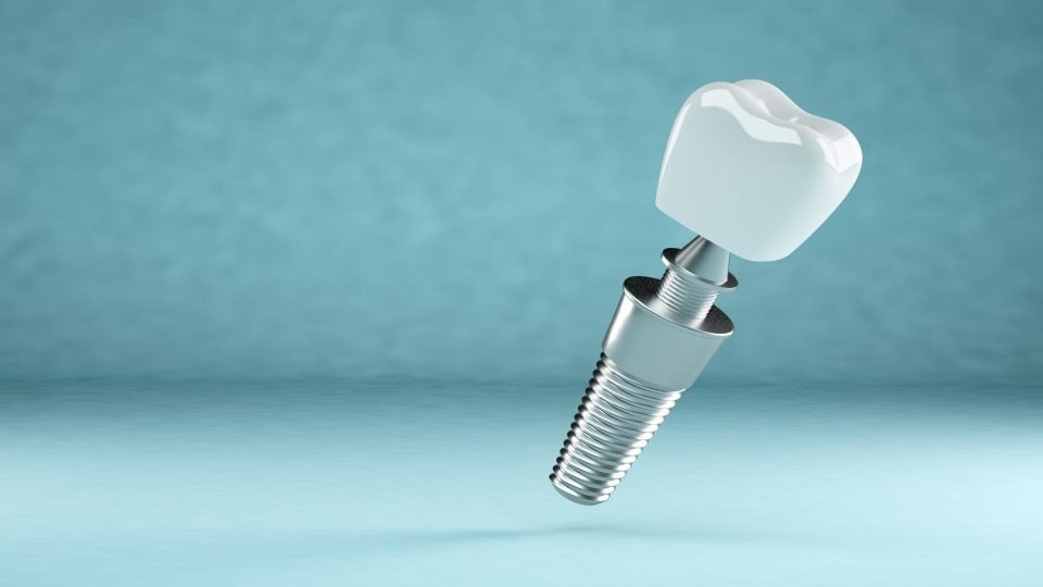 implant diş fiyatları