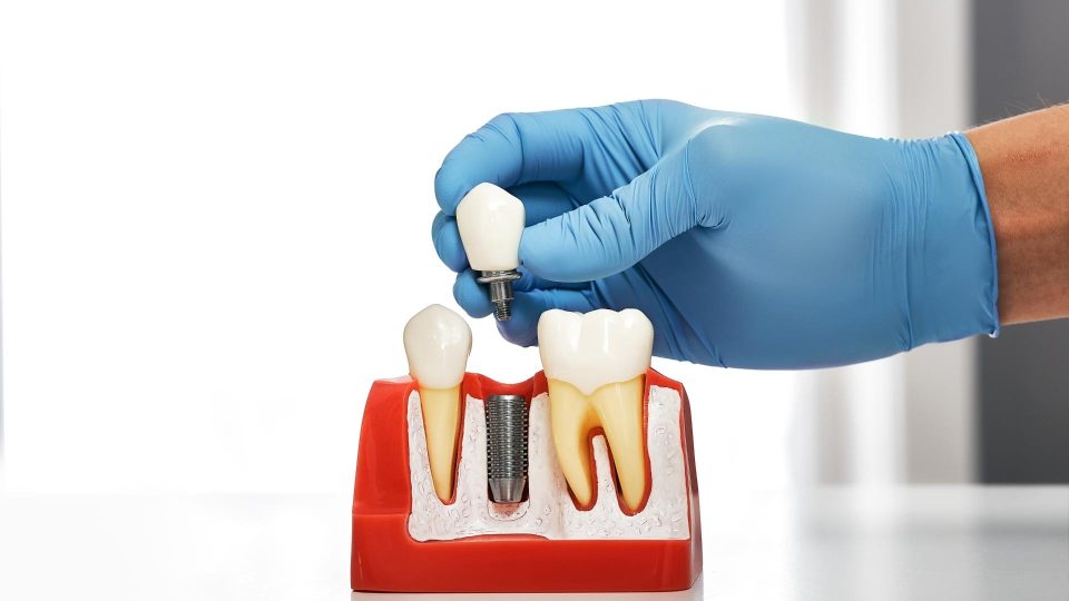 implant diş nasıl uygulanır