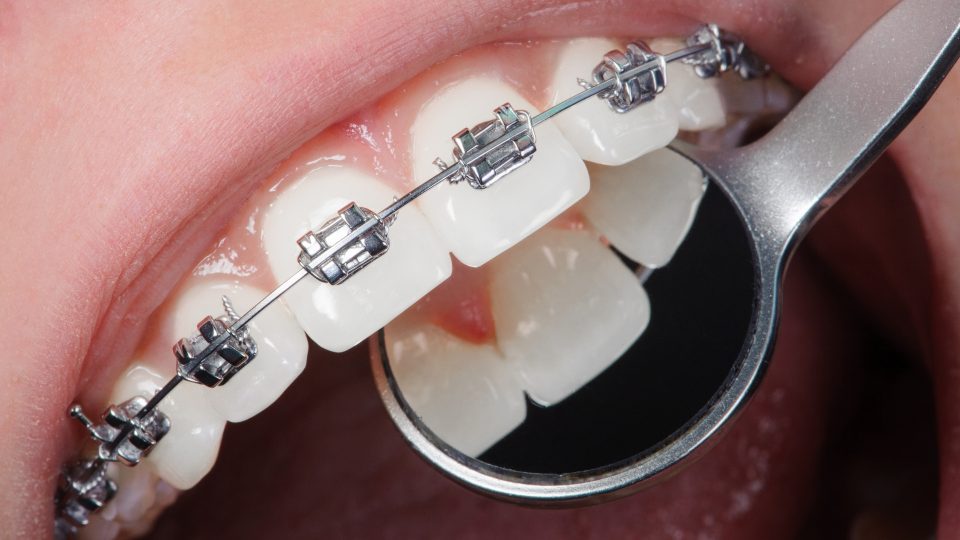 ortodontik tedavi süresi